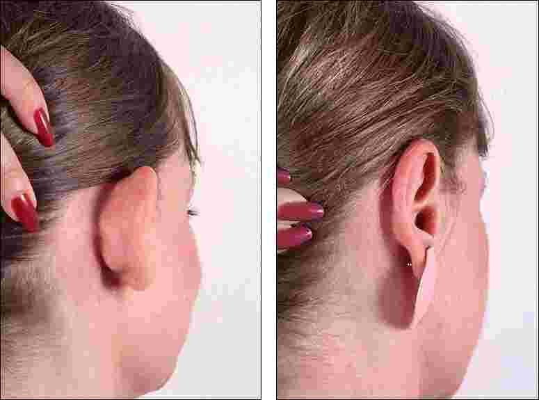Kepçe Kulak Ameliyatı Nasıl Olur?
